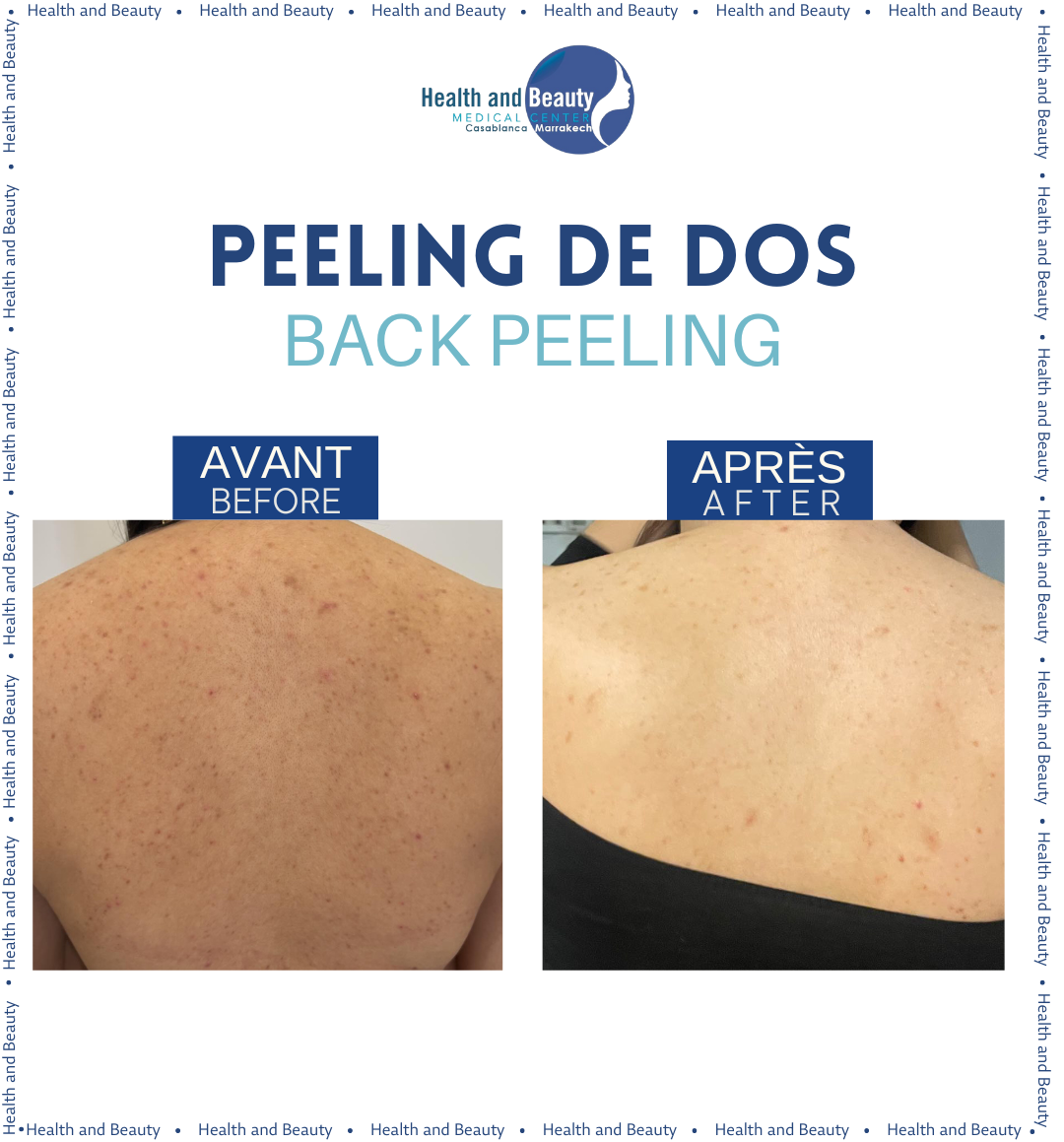 resultat peeling dos pigmentation